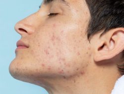 Gonta-ganti Skincare Bisa Sebabkan Jerawat, Ini Penjelasan Dokter