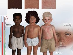 Mengapa Campak Menyebabkan Ruam Merah?