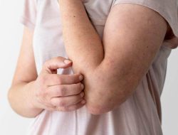 Keluyuran Saat Campak, Apakah Menular?